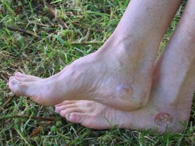 Walking in France: Blisters everywhere
