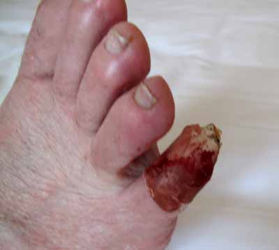 Walking in France: Such a little toe, but so much pain!